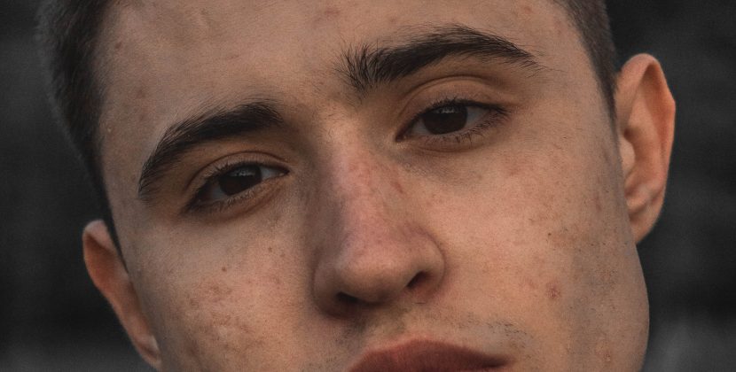 The Complete Guide To Acne Prevention And Treatment – Get Clear Skin For Good!