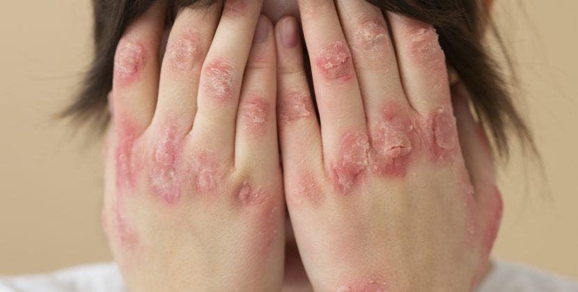 When Should You Worry About Your Child’s Chickenpox?