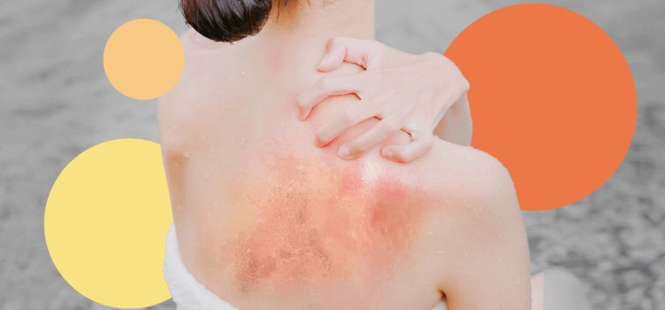 An Eye-Opening Fact About Sunburn You Need to Know