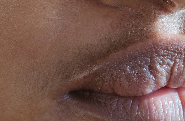 All You Need to Know About Blackhead Formation and Treatment