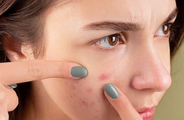 Skin Care on a Shoestring: 15 Cheap and Effective Ways to Treat Acne