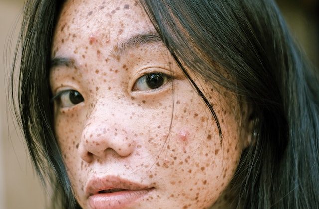 Say Goodbye to Hyperpigmentation with Cysteamine for Skin