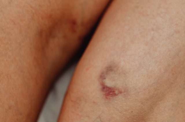 Say goodbye to unsightly bruises easy methods to promote faster healing