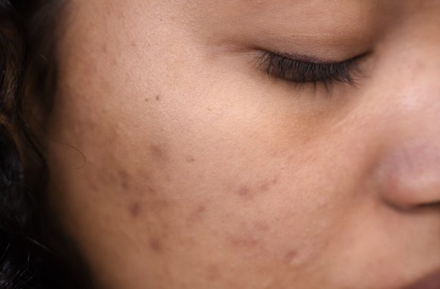 Don’t Let These Skincare Slip-Ups Ruin Your Complexion: The Worst Mistakes for Acne-Prone Skin