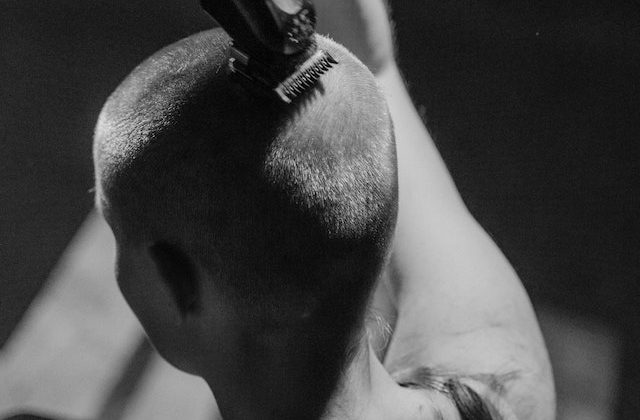 The Emotional Toll of a Bad Hair Transplant: How I Became an Expert at Hiding