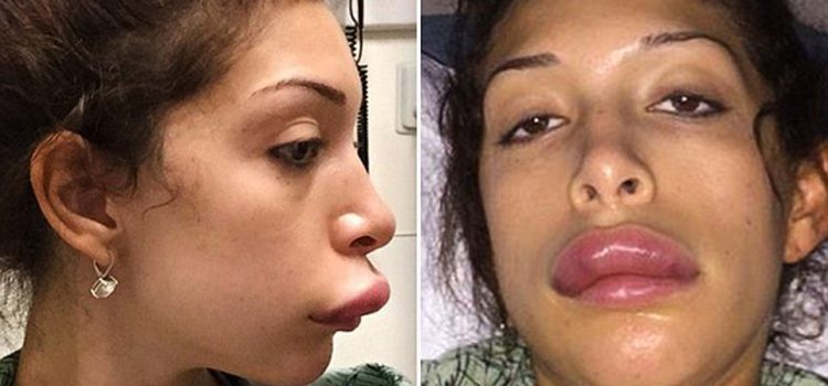 Dealing with Lip Filler Mishaps: Coping Strategies for the Aftermath