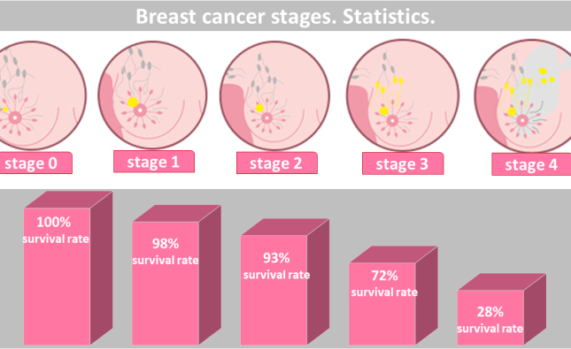 Decoding the Stages of Breast Cancer: An Expert Analysis