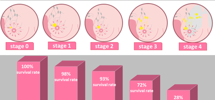 Decoding the Stages of Breast Cancer: An Expert Analysis