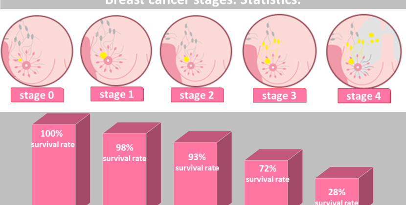 Decoding the Stages of Breast Cancer: An Expert Analysis