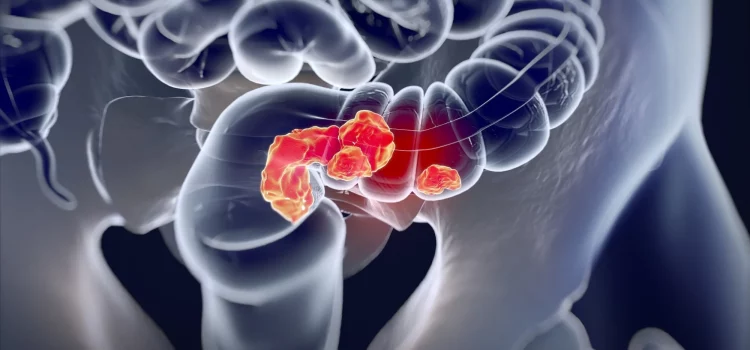 Unraveling Young-Onset Colorectal Cancer: Scientific Insights