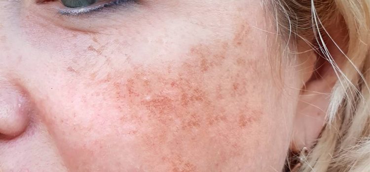 The Dark Side of Skin: Deep Dive into Hyperpigmentation and Melasma