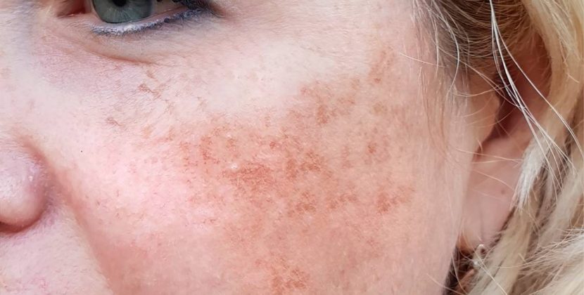 The Dark Side of Skin: Deep Dive into Hyperpigmentation and Melasma