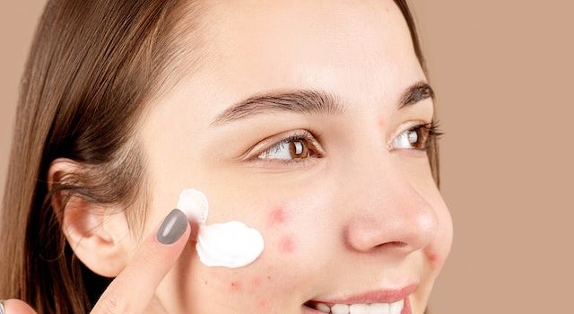 Get Rid of Acne Naturally: 14 Effective Ways to Say Goodbye to Pimples