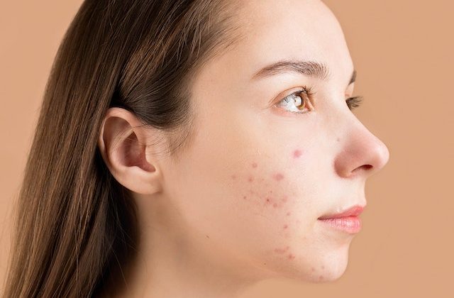 Acne Issue
