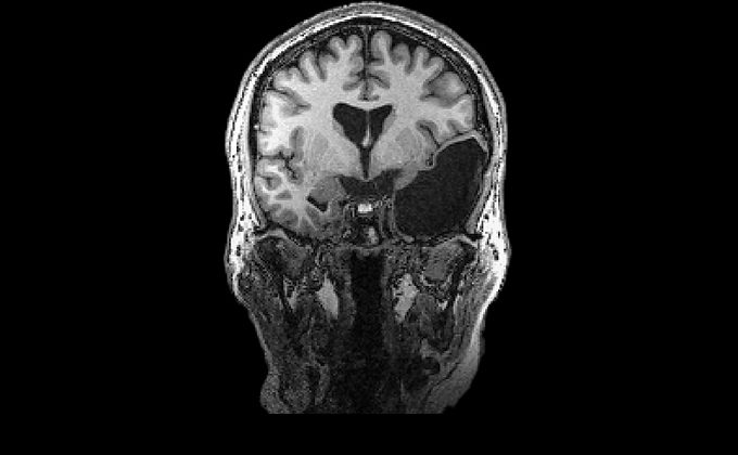 Brain Gap