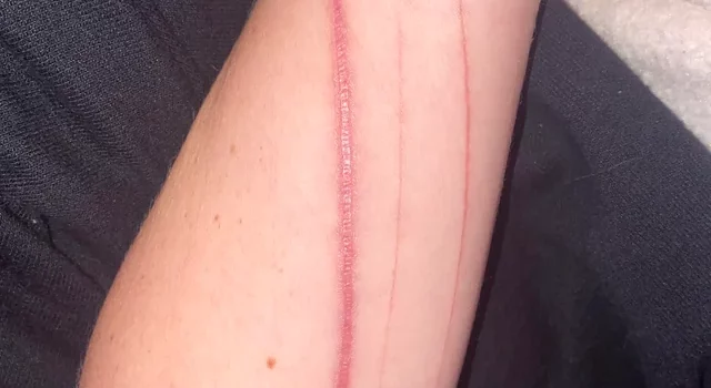 Mastering Keloid Scars: Facts and Solutions