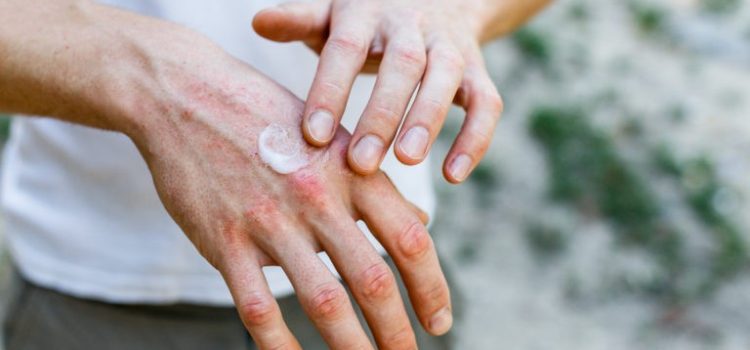 Living with Skin Disorders: Strategies for Managing Skin Diseases