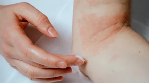 Eczema