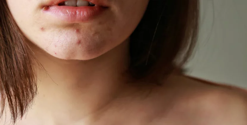 Annoying Chin Blackheads