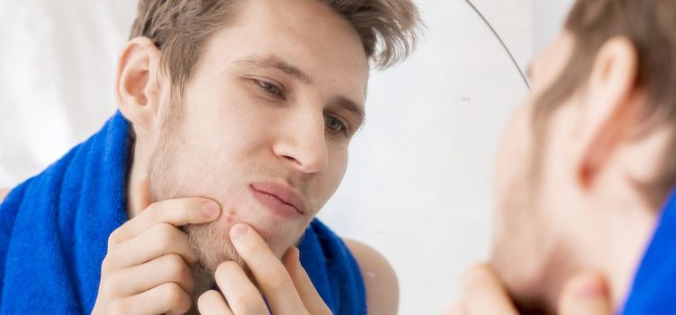 The Acne Avoidance Guide: What to Skip for Flawless Skin