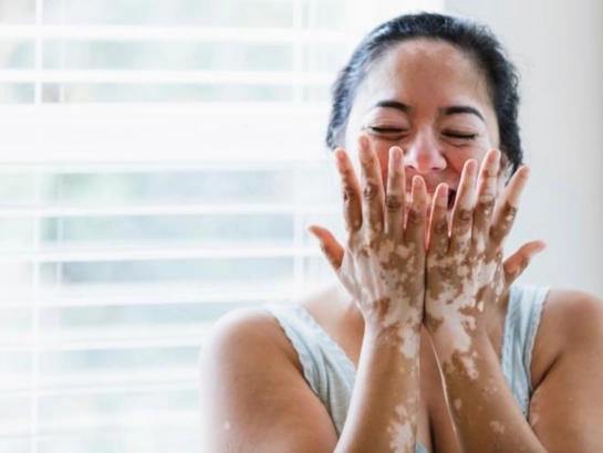 Vitiligo Prevention