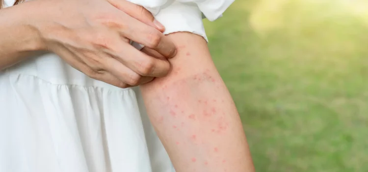 Buzz Off Itch: Discover 5 Home Remedies to Banish Mosquito Bite Discomfort