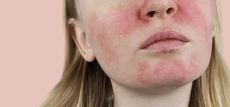 Gentle Healing: Effective Home Remedies for Red Skin Relief