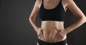  Stubborn Stretch Marks