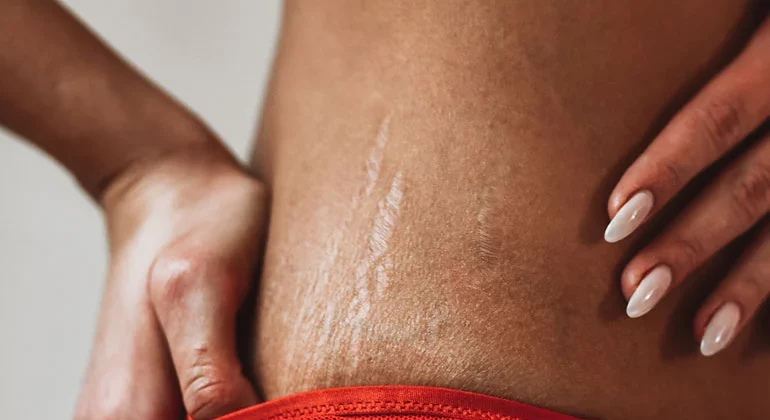Stubborn Stretch Marks