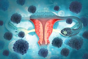 Signs of Ovarian Cancer