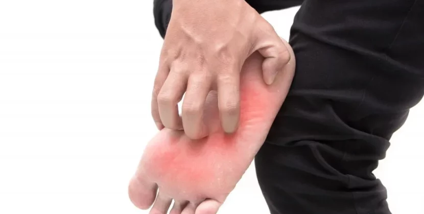 burning feet