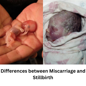 Stillbirth vs Stillborn
