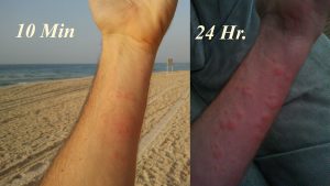 Sea Lice Rash