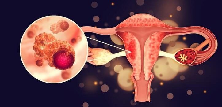 All You Need to Know About Ovarian Cancer