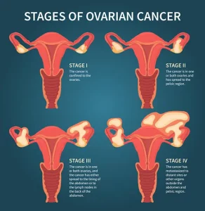 Ovarian Cancer 