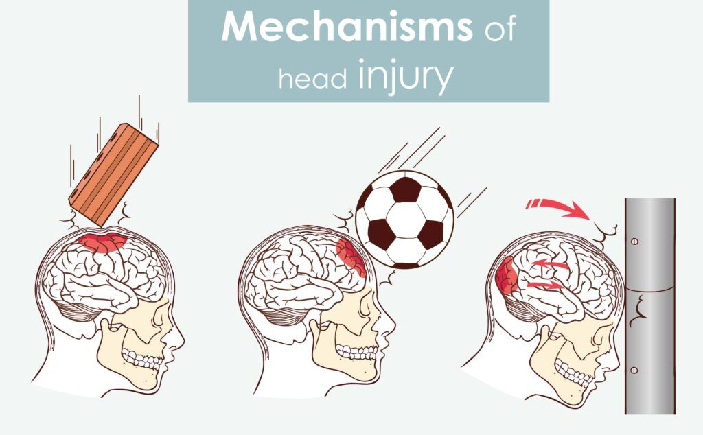 A Guide to Recognizing and Treating Head Injuries