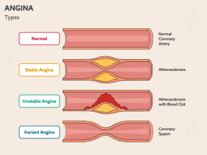 Types of Angina