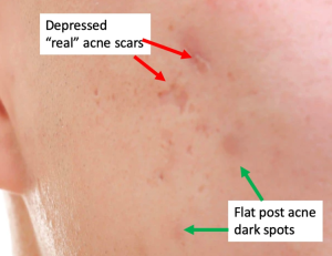  Acne Scars