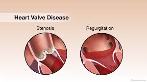 Heart Valves