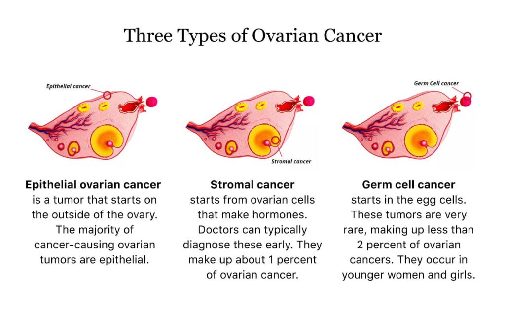 All You Need to Know About Ovarian Cancer