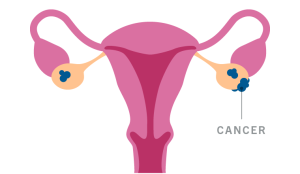 Ovarian Cancer 