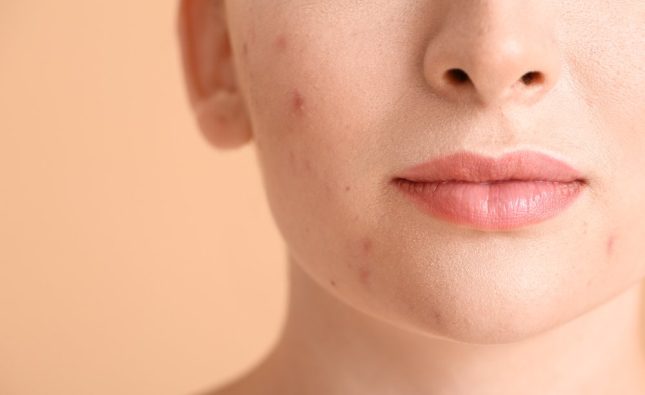 Facial Suctioning Cups for Acne-Prone Skin: Helpful or Harmful?