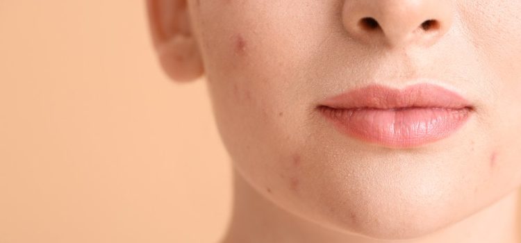 Facial Suctioning Cups for Acne-Prone Skin: Helpful or Harmful?