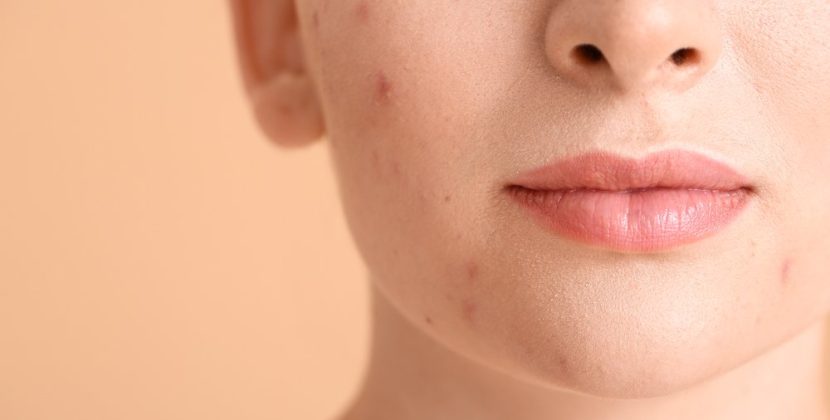 Facial Suctioning Cups for Acne-Prone Skin: Helpful or Harmful?
